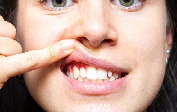 boca-de-una-mujer-con-encias-rojas-inflamacion-causada-por-gingivitis-Catarroja boca-de-una-mujer-con-encias-rojas-inflamacion-causada-por-gingivitis-Valencia