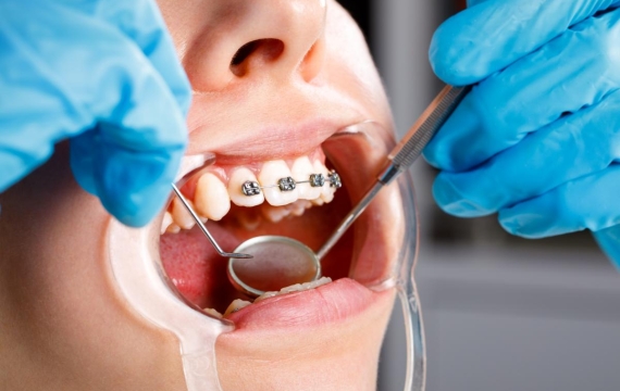 mordedura de los dientes mordedura de los dientes