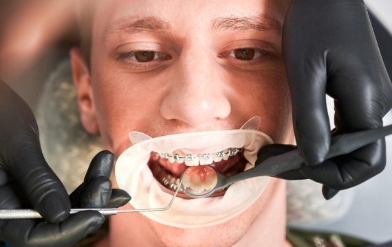 perdidas de dientes en Catarroja perdidas de dientes en Valencia