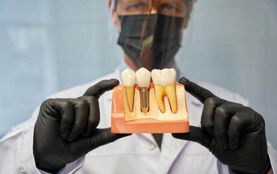 modelo de implantes catarroja modelo de implantes