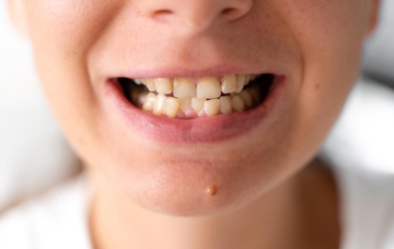 dientes desviados dientes desviados