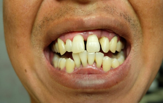 dientes torcidos Catarroja dientes torcidos Valencia