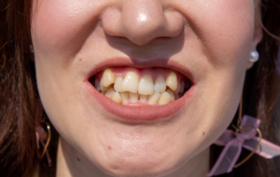 dientes desalineados Catarroja dientes desalineados