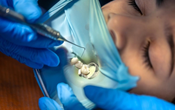 extraccion de muelas catarroja extraccion de muelas