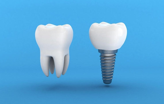 tipos de implantes catarroja tipos de implantes en Valencia