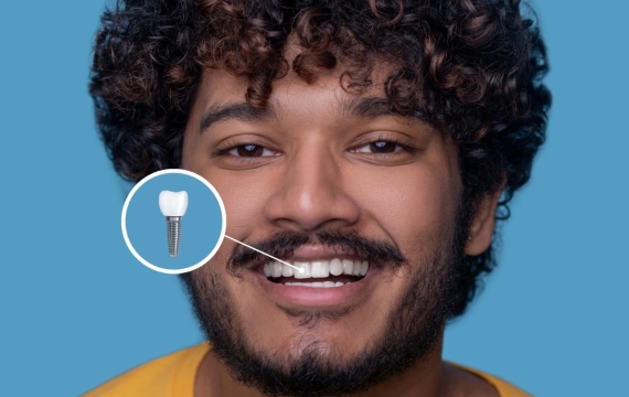 implantología catarroja implantología catarroja