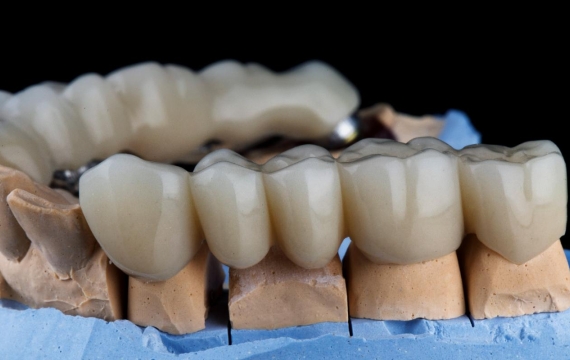 implantes-dentales-con-protesis-fija-catarroja implantes-dentales-con-protesis-fija-Valencia