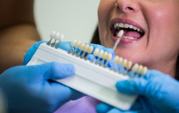 kit-blanqueamiento-dental-catarroja kit-blanqueamiento-dental