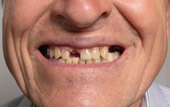 perdida-de-dientes-Catarroja perdida-de-dientes-Valencia