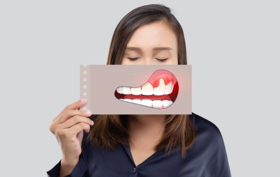 periodontitis catarroja periodontitis Valencia