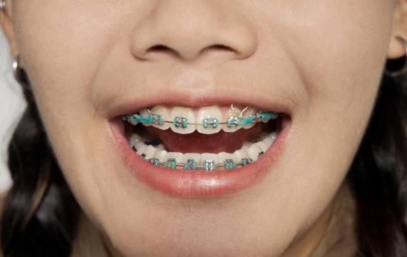 aparatos dentales catarroja aparatos dentales