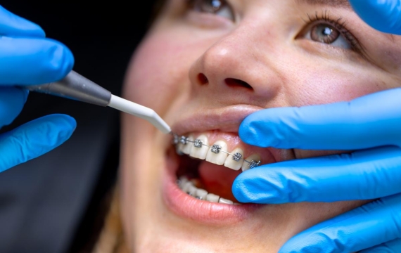 alineamiento dental en Catarroja alineamiento dental