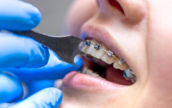 ceras para brackets en Catarroja ceras para brackets