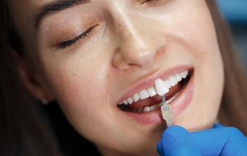 carillas-de-composite